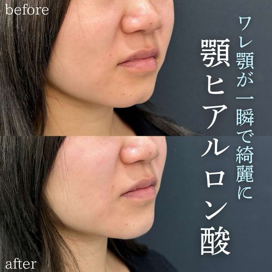 アゴクレヴィエルの症例写真
