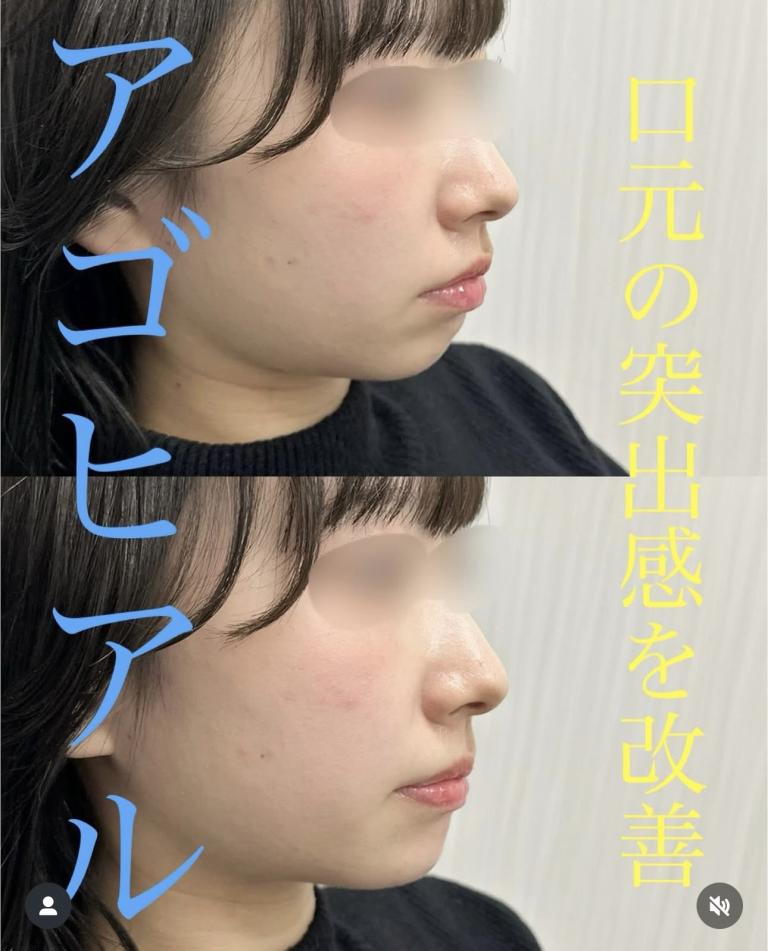 アゴクレヴィエルの症例写真