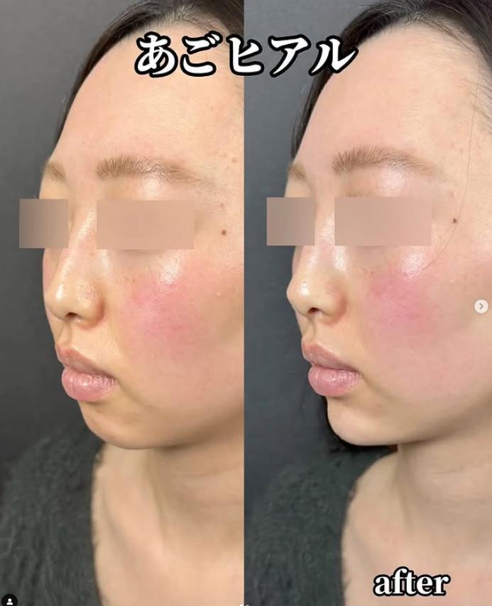 アゴクレヴィエルの症例写真