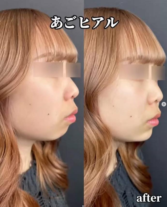 アゴクレヴィエルの症例写真