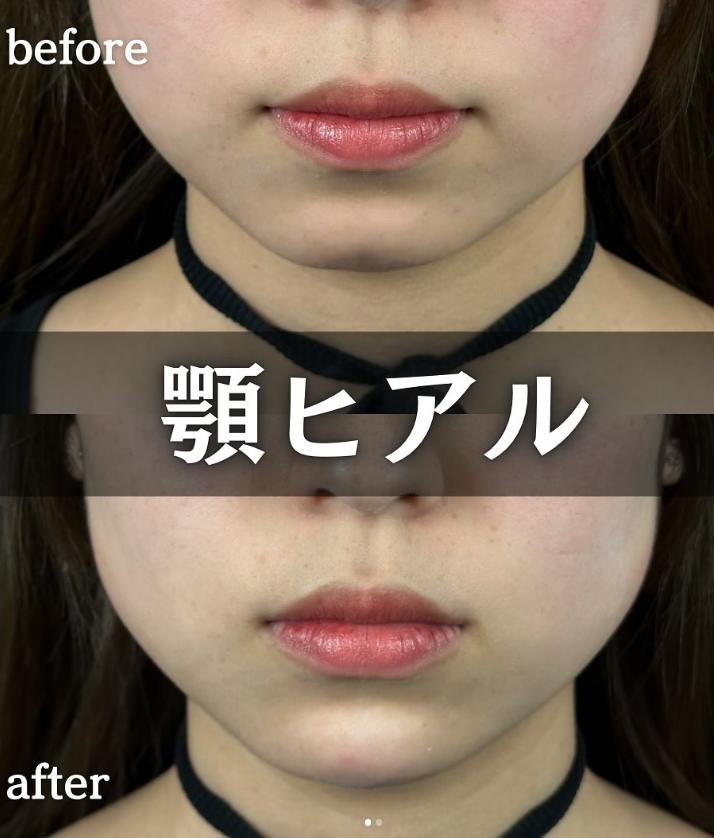 アゴクレヴィエルの症例写真