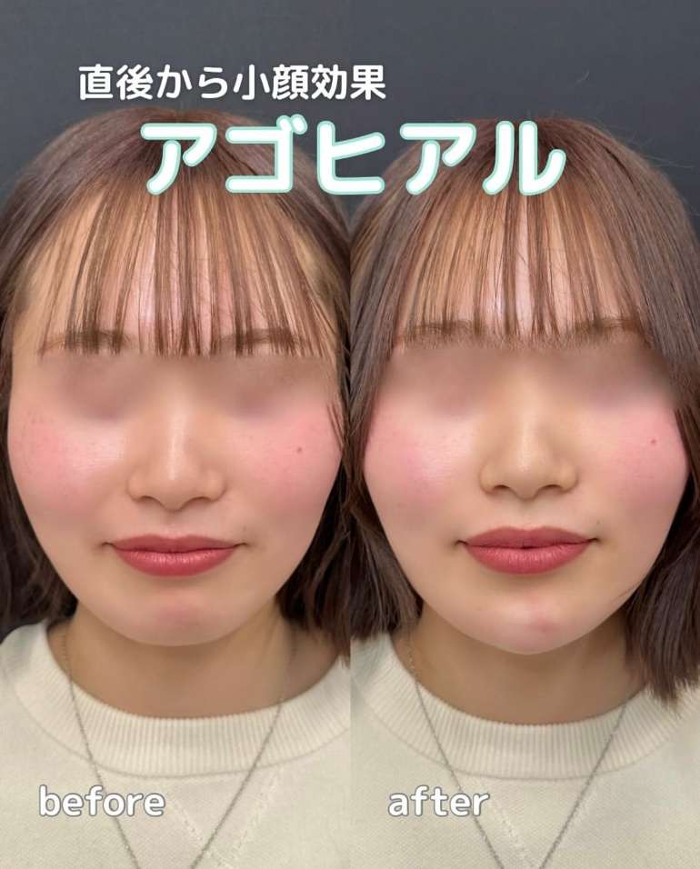 アゴクレヴィエルの症例写真