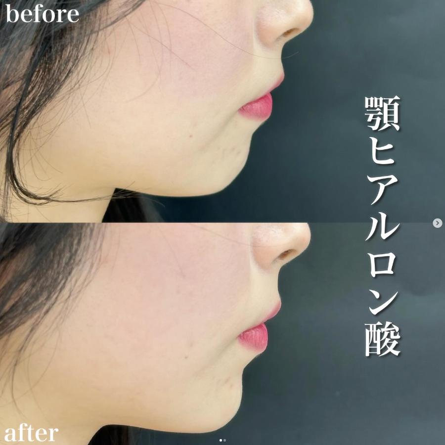 アゴクレヴィエルの症例写真