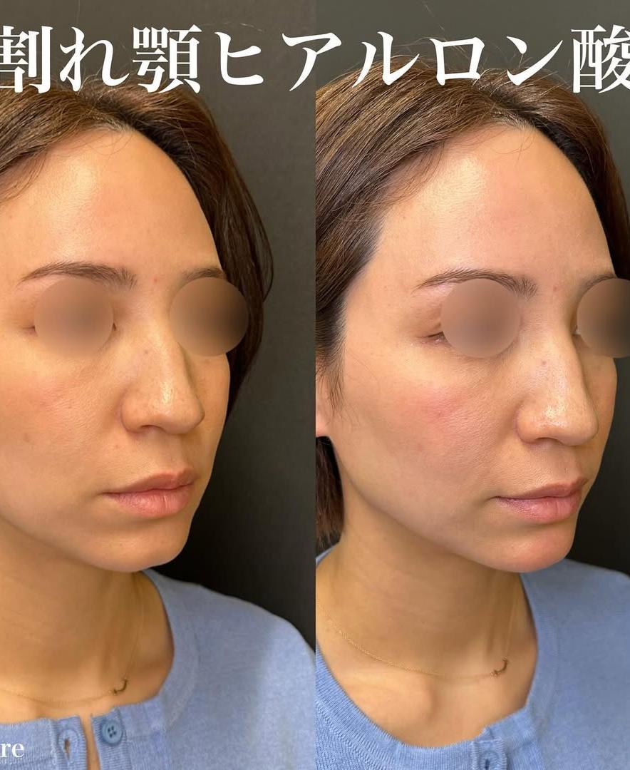 アゴクレヴィエルの症例写真