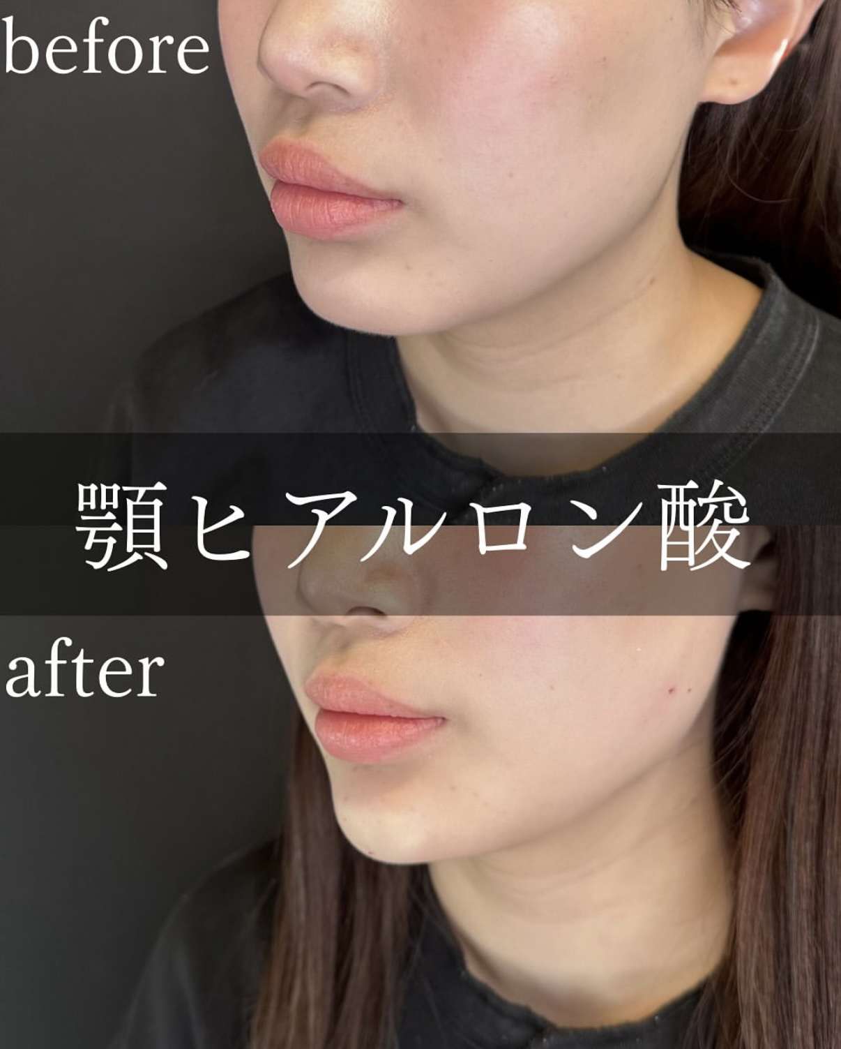 アゴクレヴィエルの症例写真