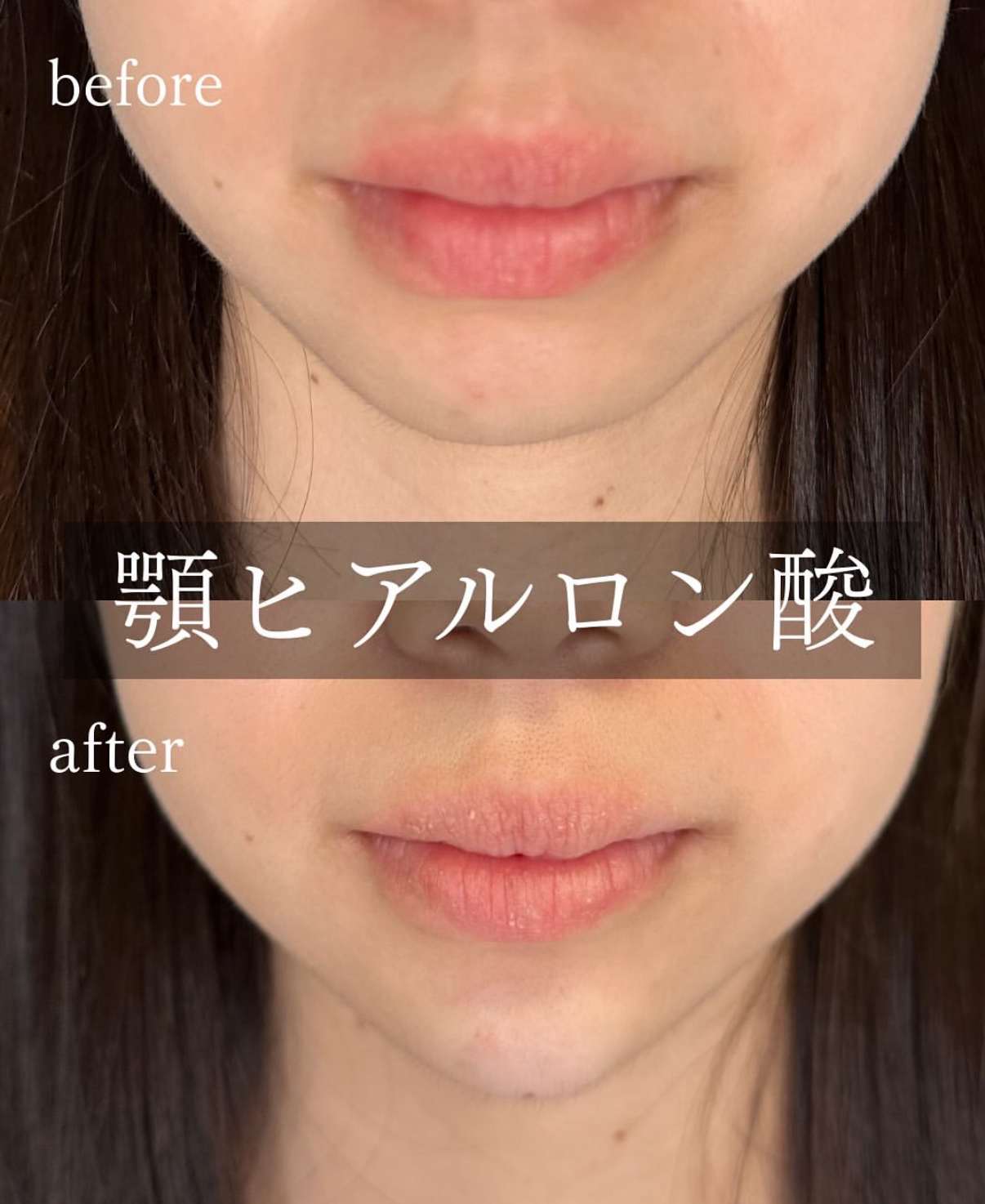 アゴクレヴィエルの症例写真