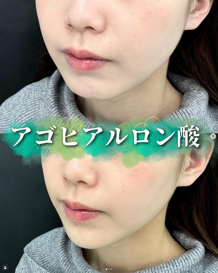アゴクレヴィエルの症例写真