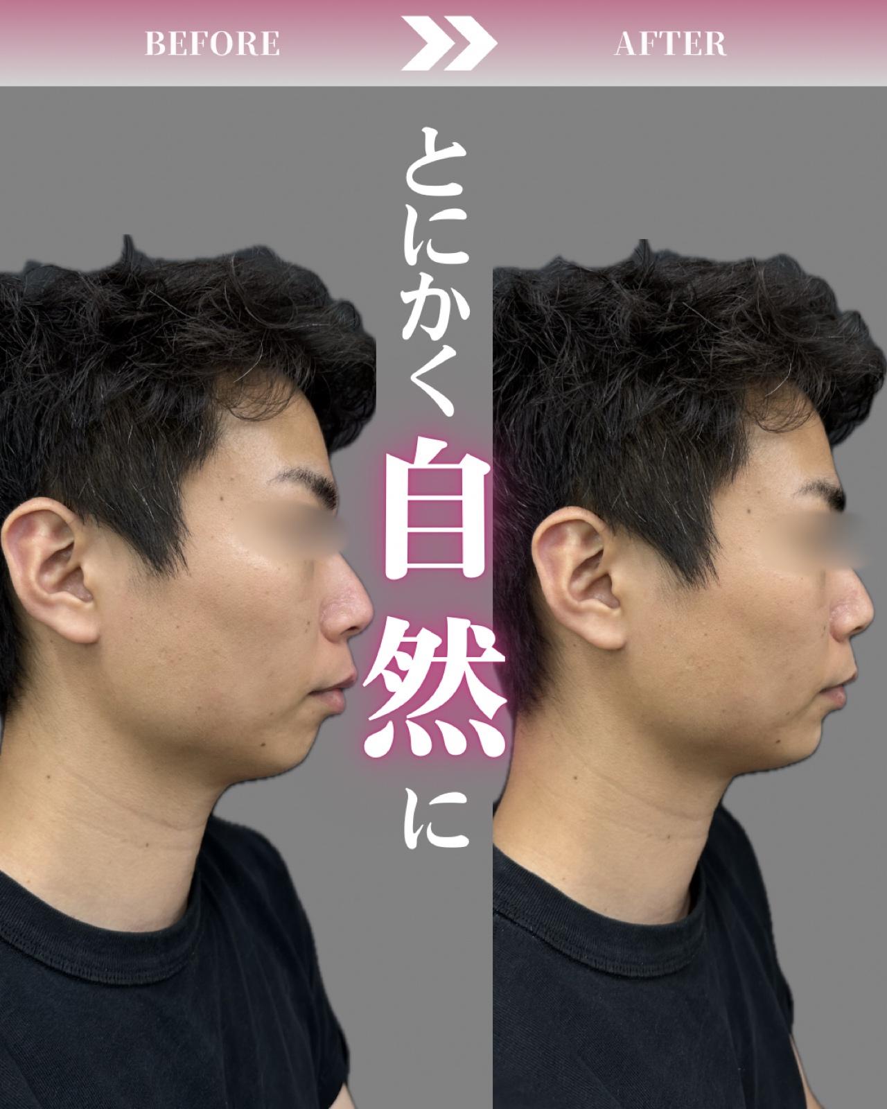 アゴクレヴィエルの症例写真