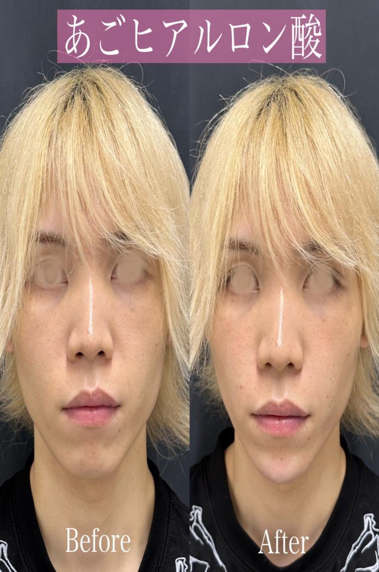 アゴクレヴィエルの症例写真