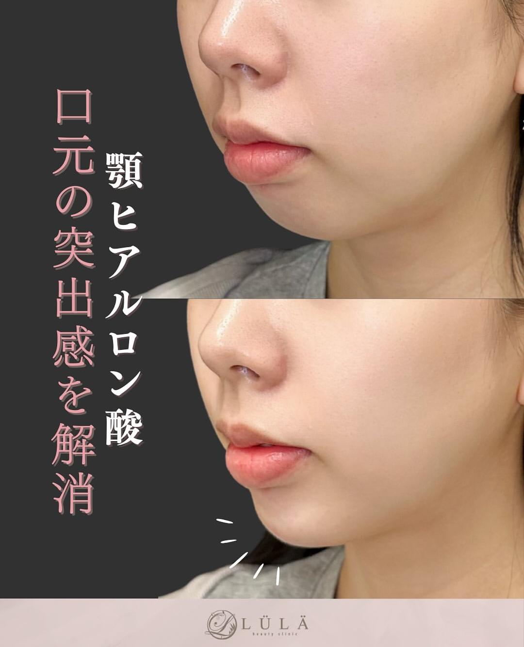 アゴクレヴィエルの症例写真