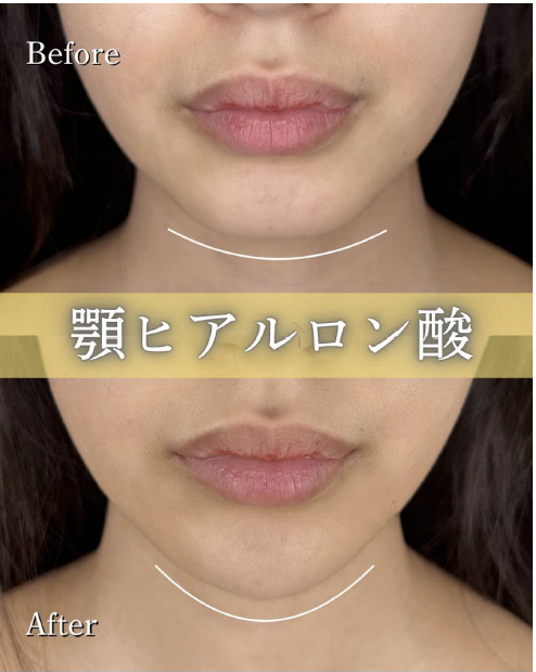 アゴクレヴィエルの症例写真