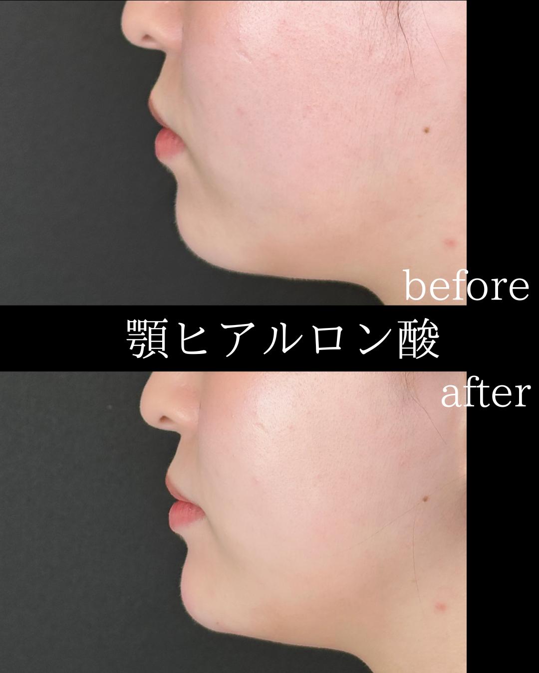 アゴクレヴィエルの症例写真