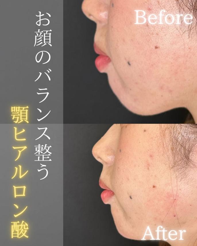 アゴクレヴィエルの症例写真