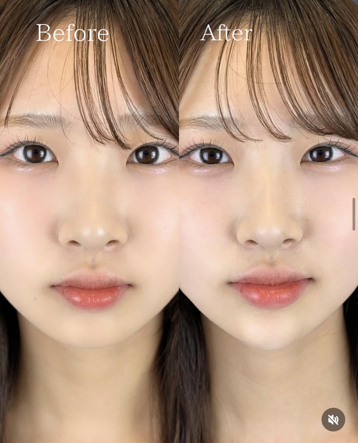 アゴクレヴィエルの症例写真