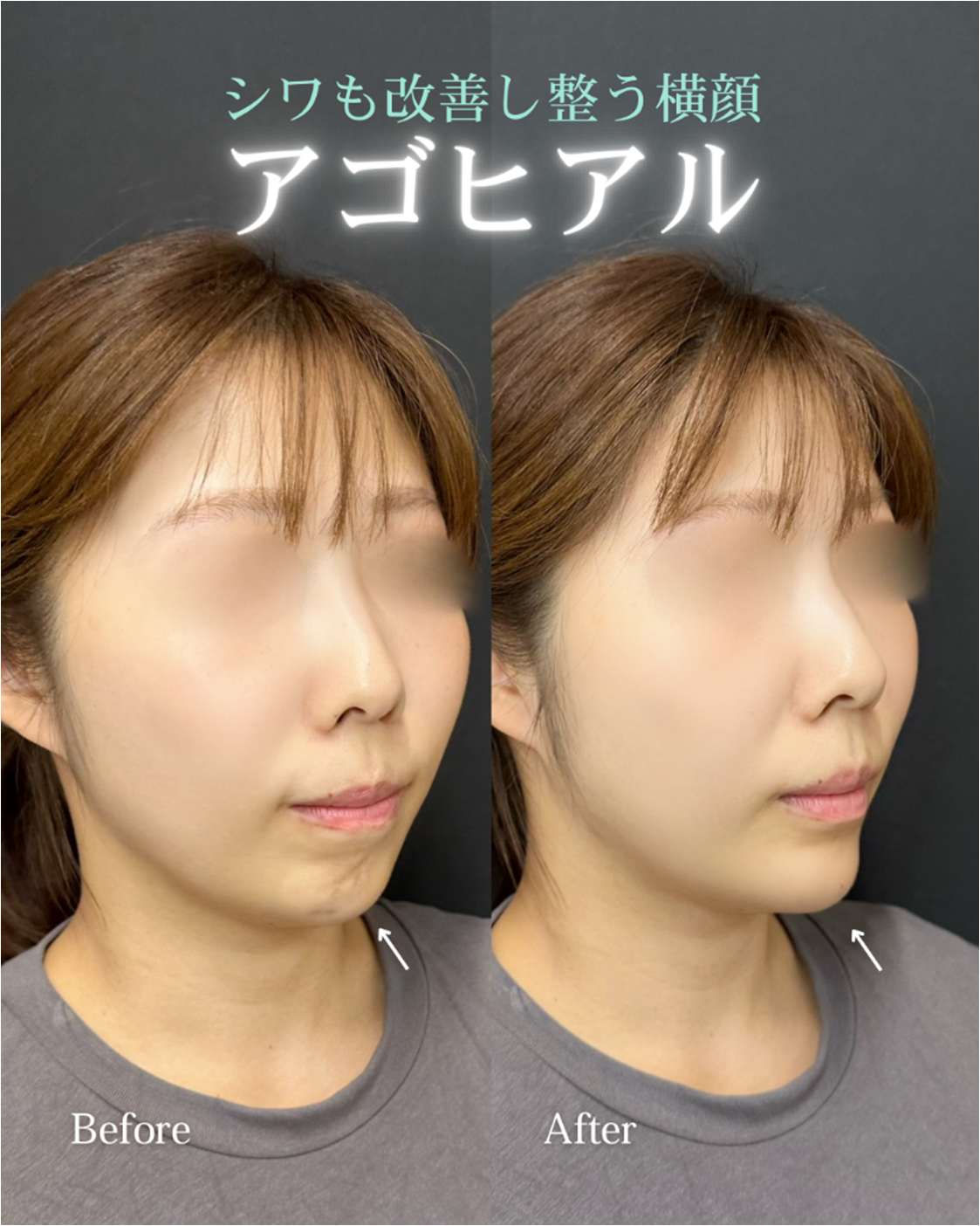 アゴクレヴィエルの症例写真