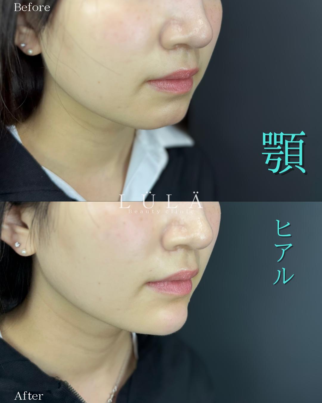 アゴクレヴィエルの症例写真