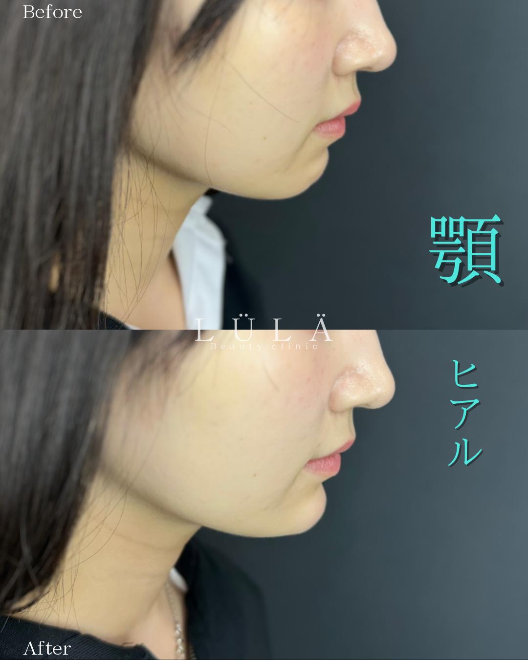 アゴクレヴィエルの症例写真