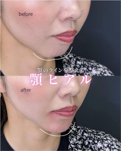 アゴクレヴィエルの症例写真