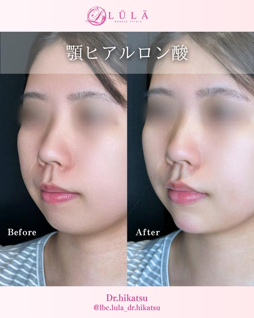 アゴクレヴィエルの症例写真