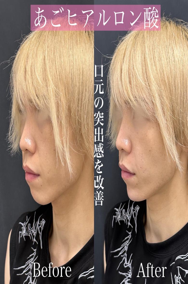 アゴクレヴィエルの症例写真