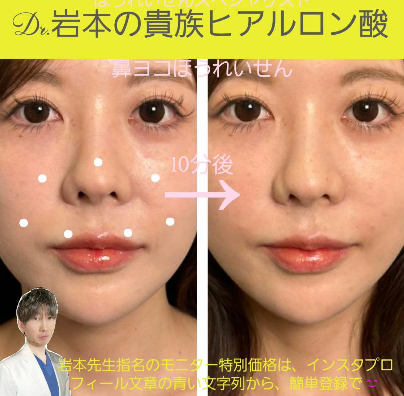 アゴクレヴィエルの症例写真