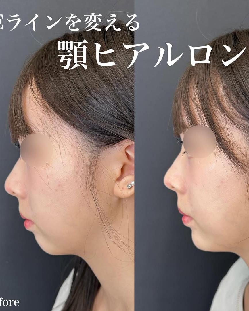 アゴクレヴィエルの症例写真