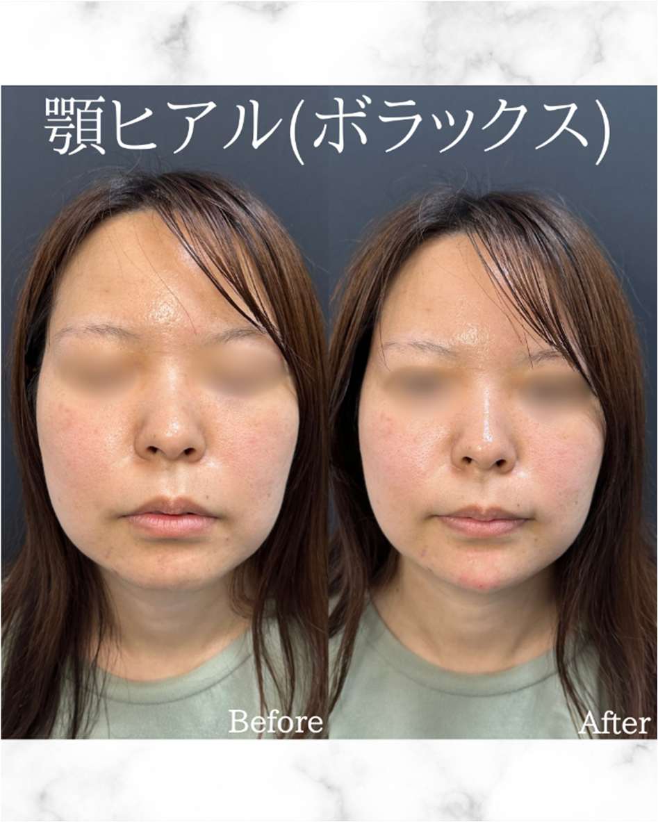 アゴクレヴィエルの症例写真