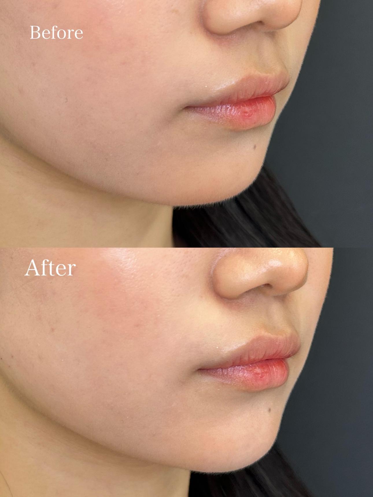 アゴクレヴィエルの症例写真