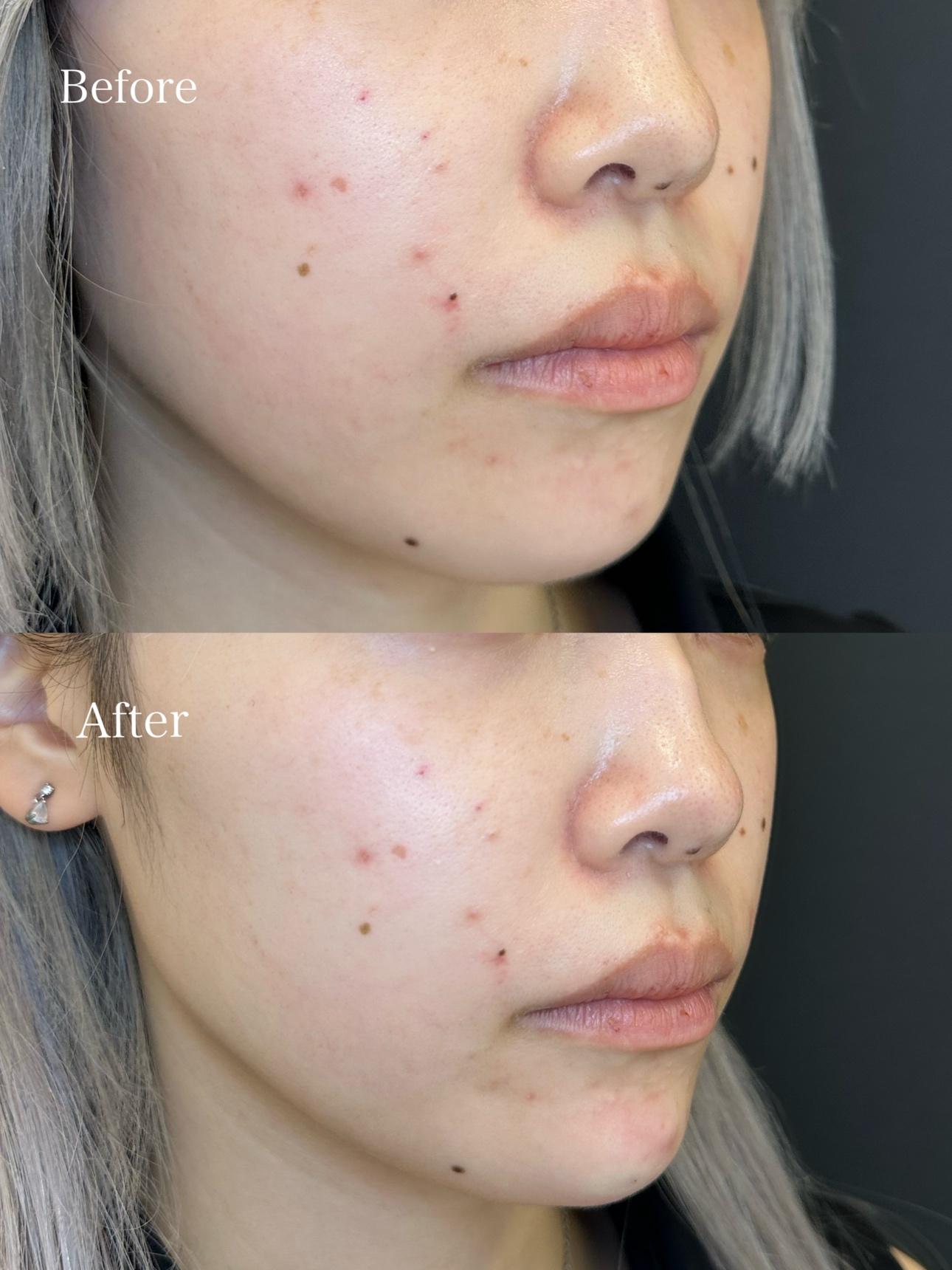 アゴクレヴィエルの症例写真