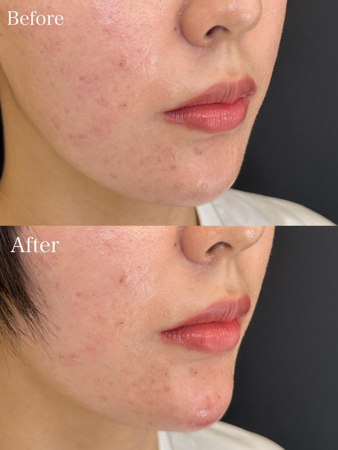 アゴクレヴィエルの症例写真