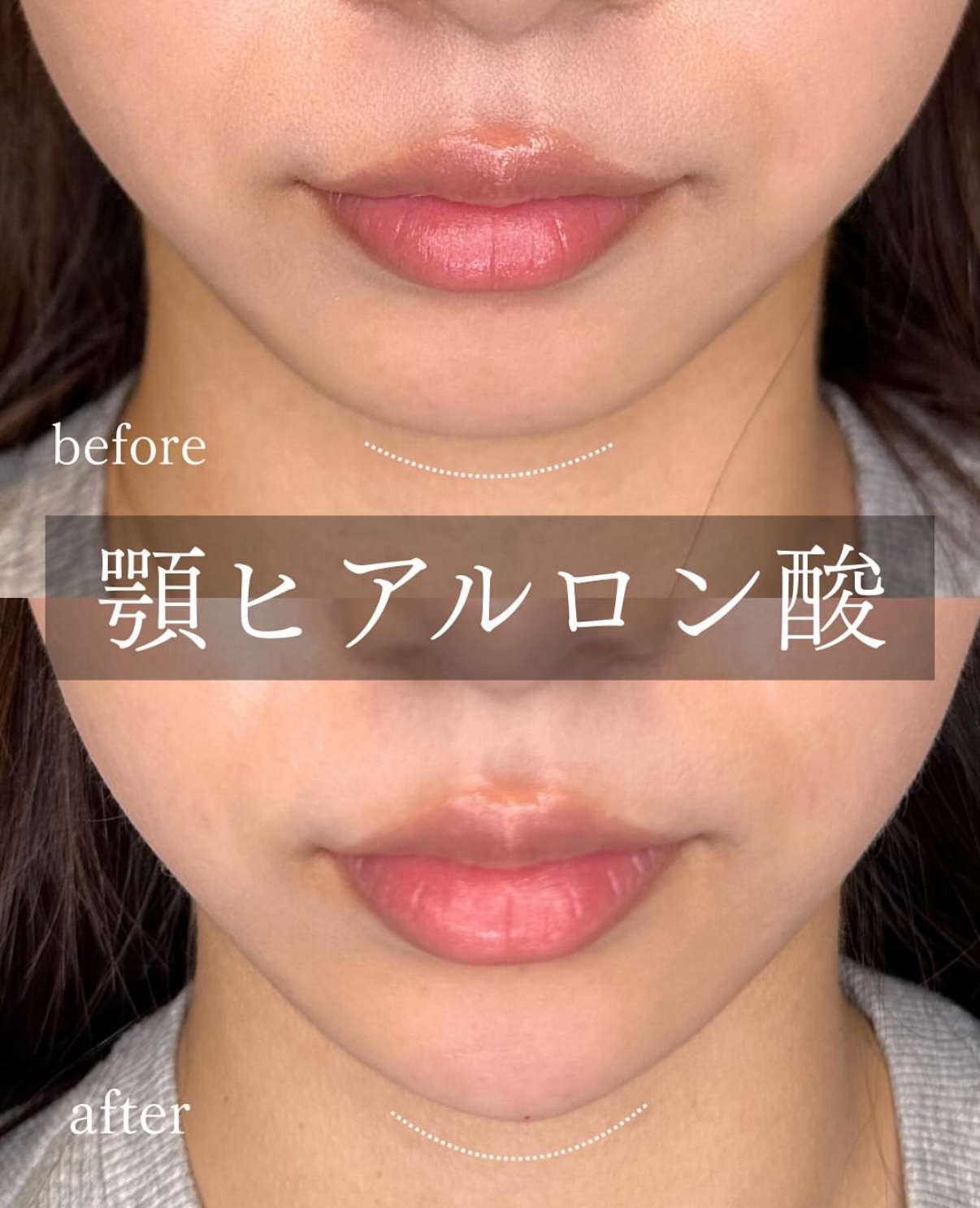 アゴクレヴィエルの症例写真