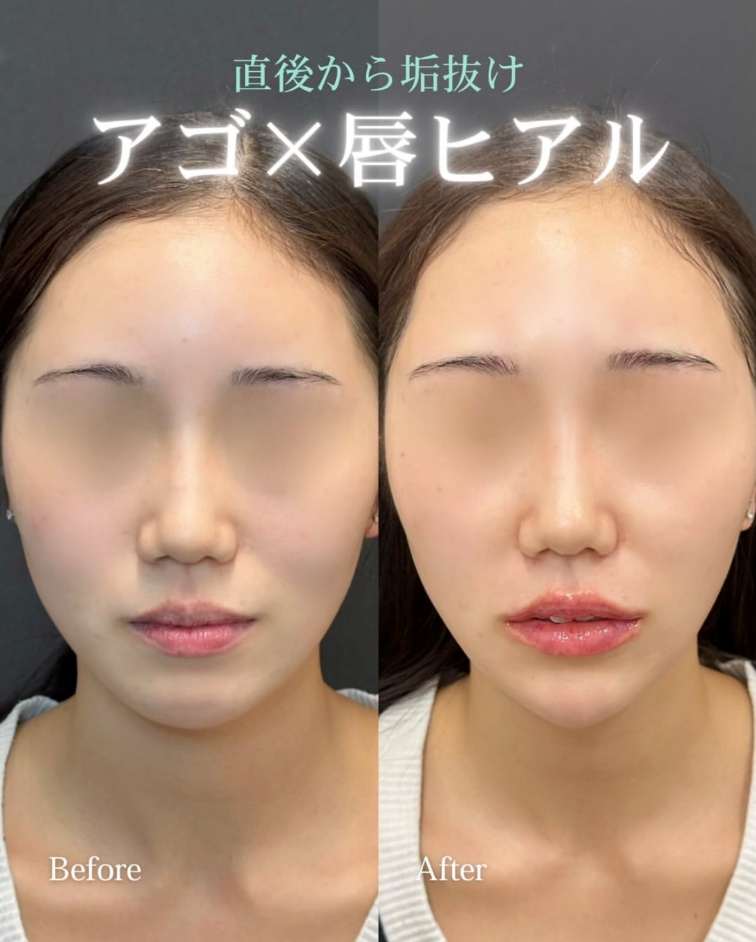 アゴクレヴィエルの症例写真