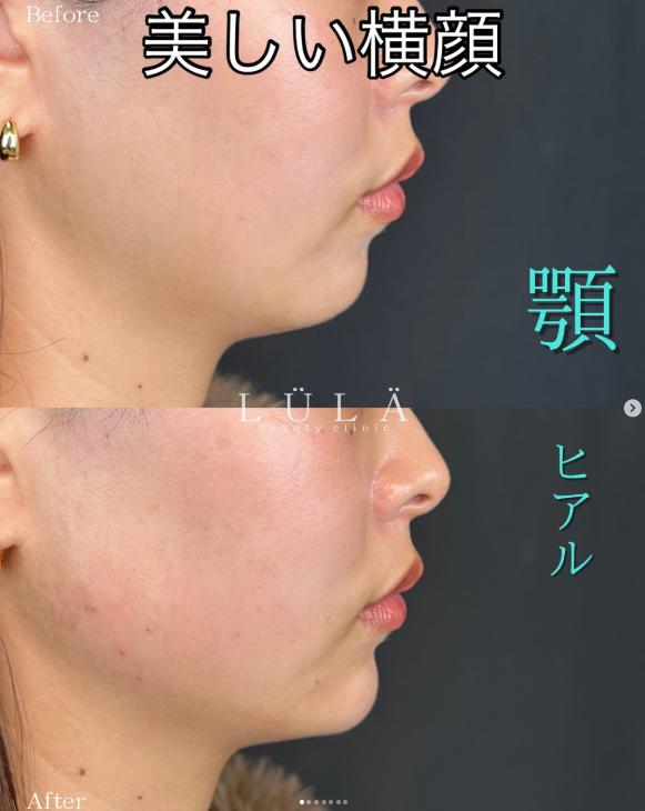 アゴクレヴィエルの症例写真