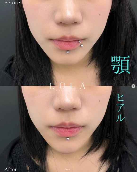 アゴクレヴィエルの症例写真