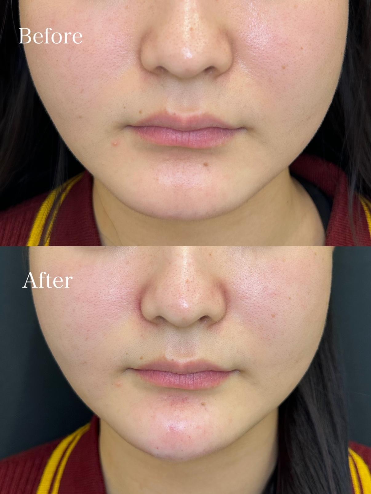 アゴクレヴィエルの症例写真