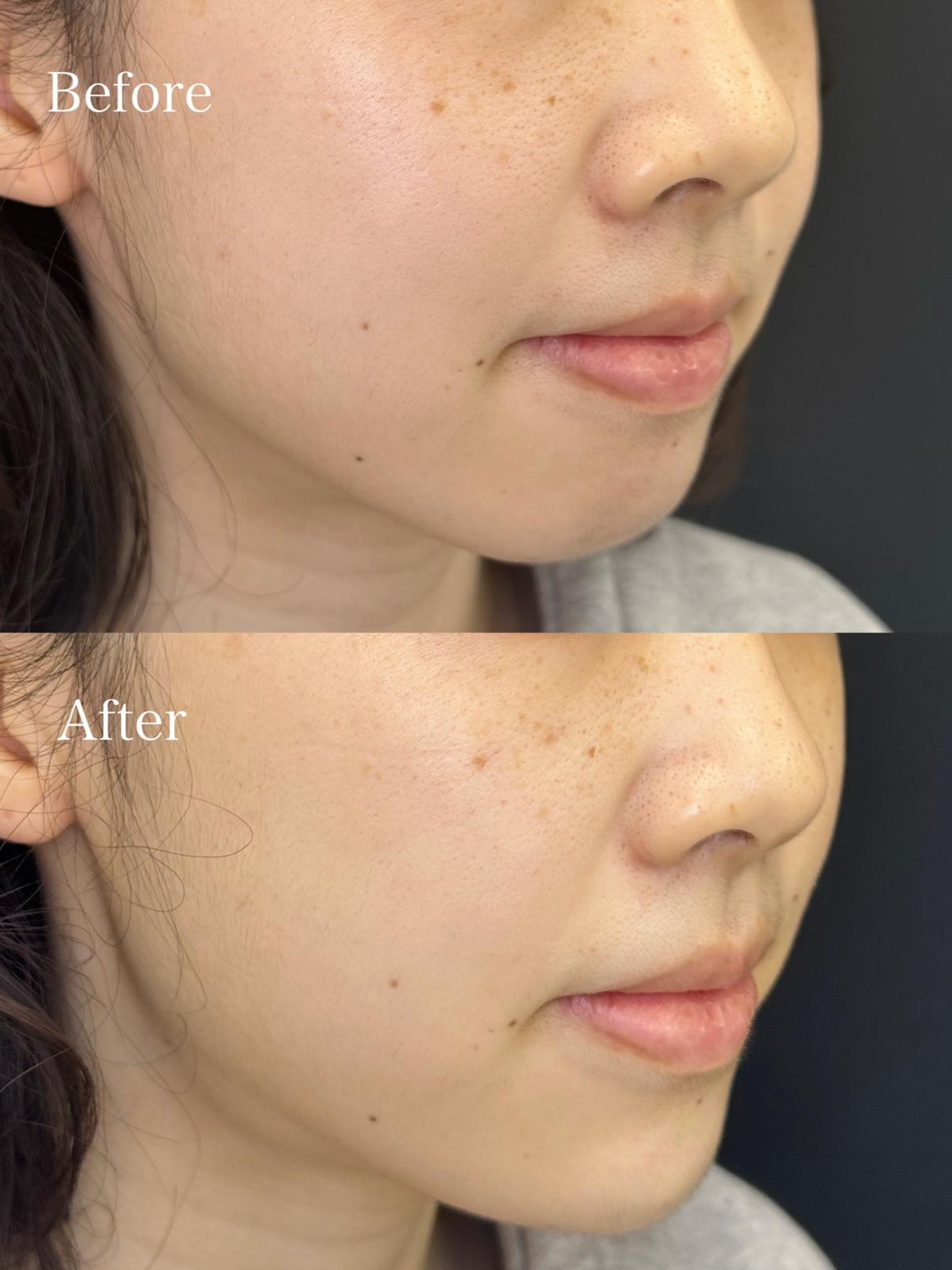 アゴクレヴィエルの症例写真