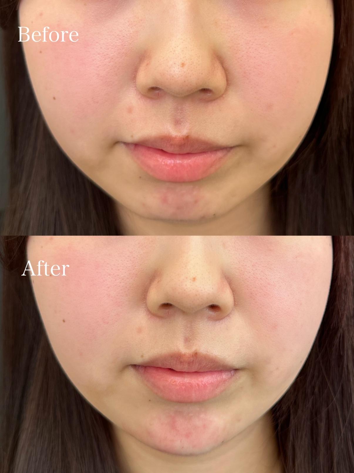 アゴクレヴィエルの症例写真