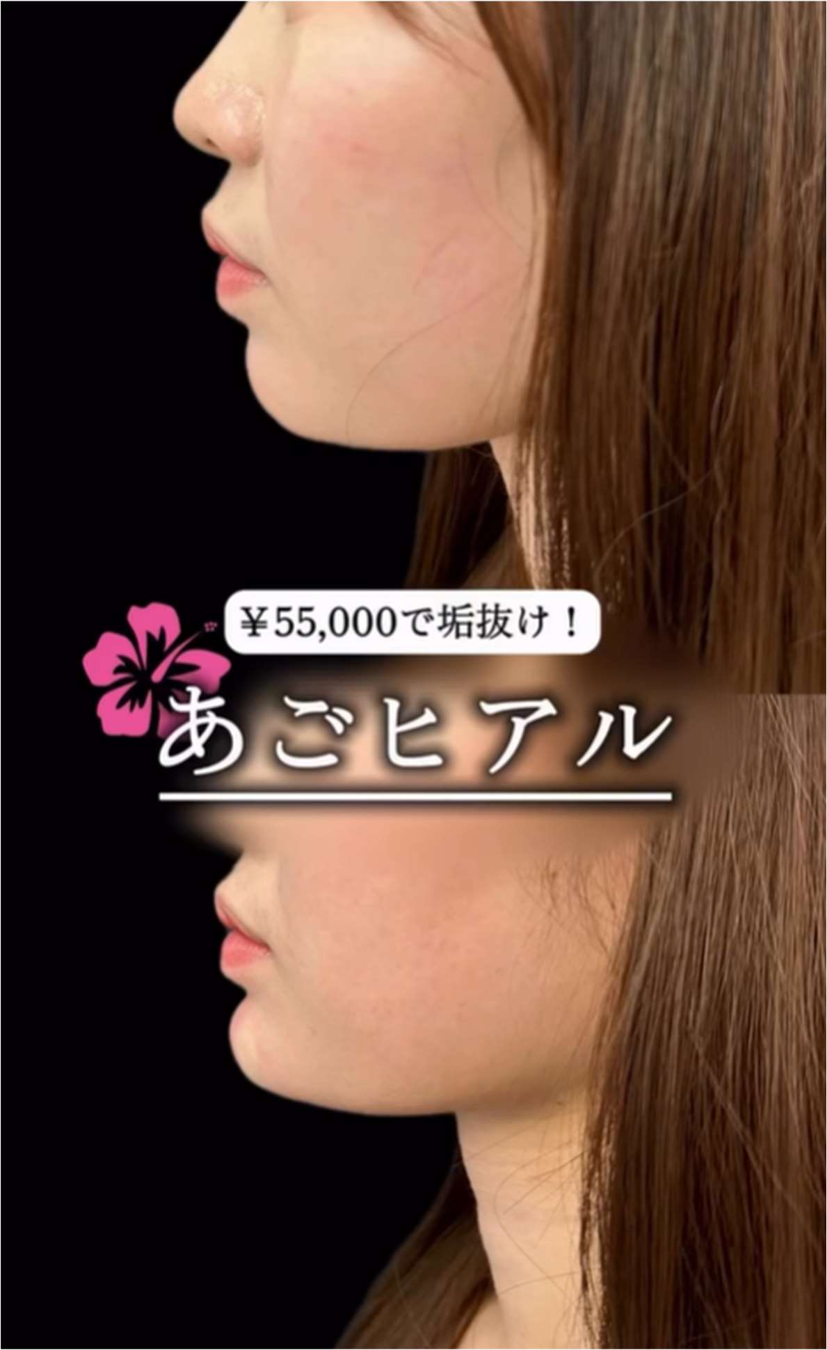 アゴクレヴィエルの症例写真