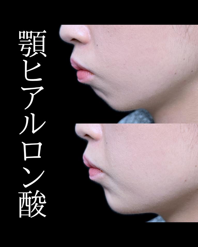 アゴクレヴィエルの症例写真