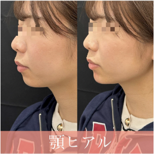 アゴクレヴィエルの症例写真