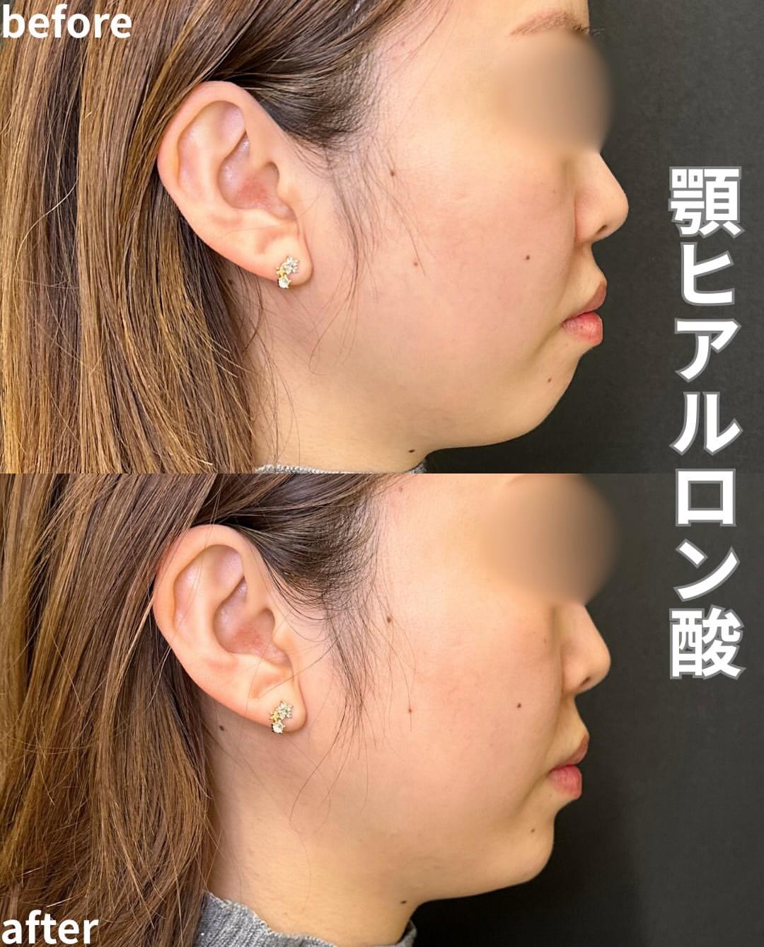 アゴクレヴィエルの症例写真