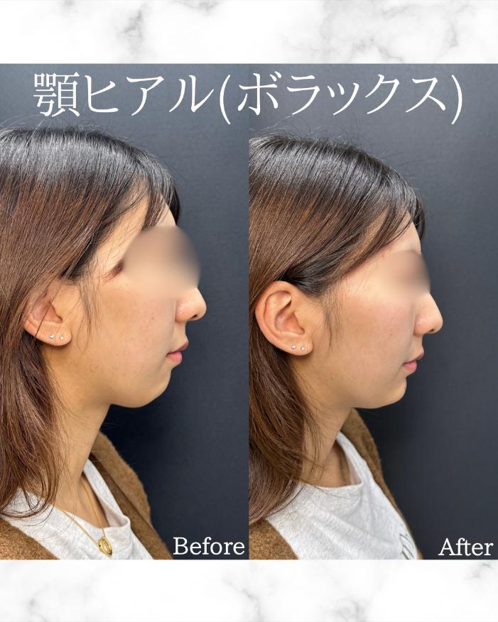 アゴクレヴィエルの症例写真