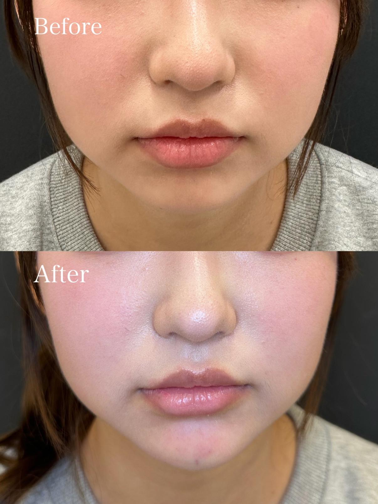 アゴクレヴィエルの症例写真