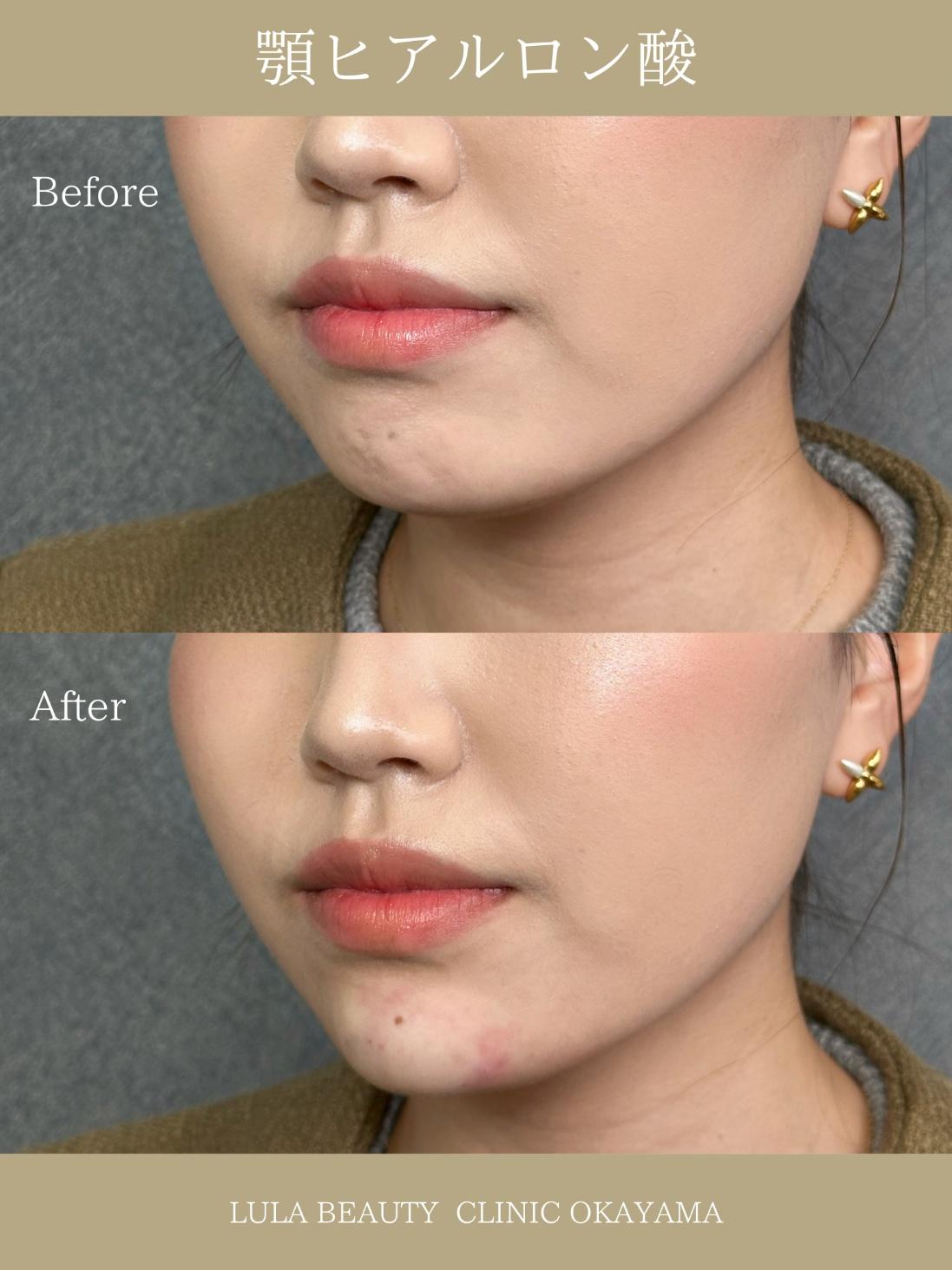 アゴクレヴィエルの症例写真