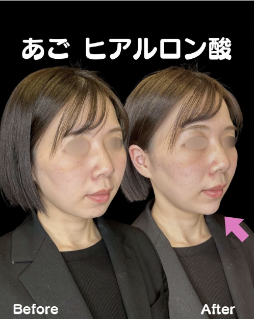 アゴクレヴィエルの症例写真