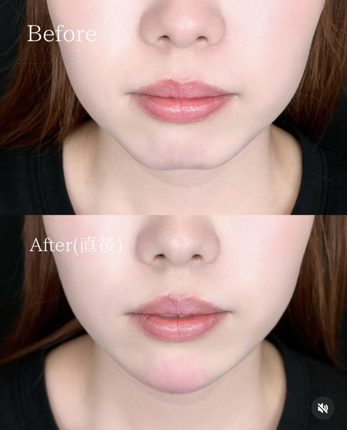 アゴクレヴィエルの症例写真