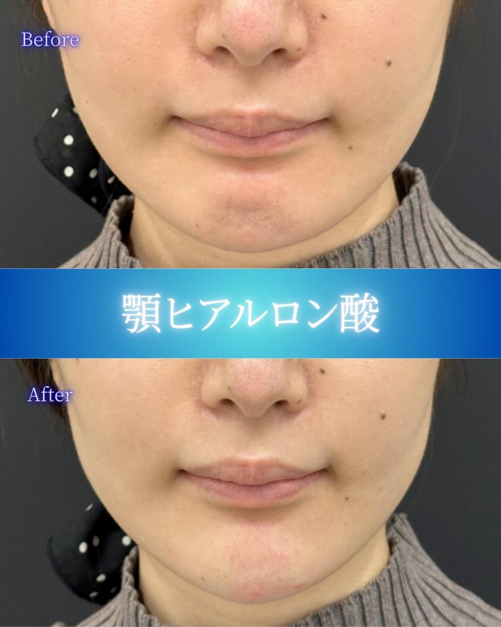 アゴクレヴィエルの症例写真