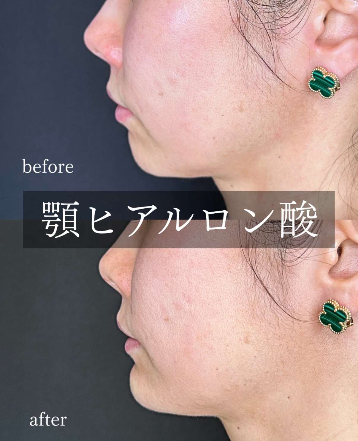 アゴクレヴィエルの症例写真