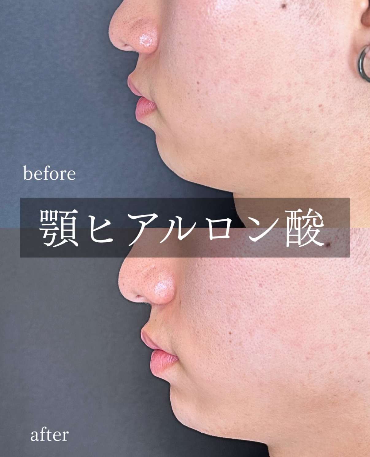 アゴクレヴィエルの症例写真