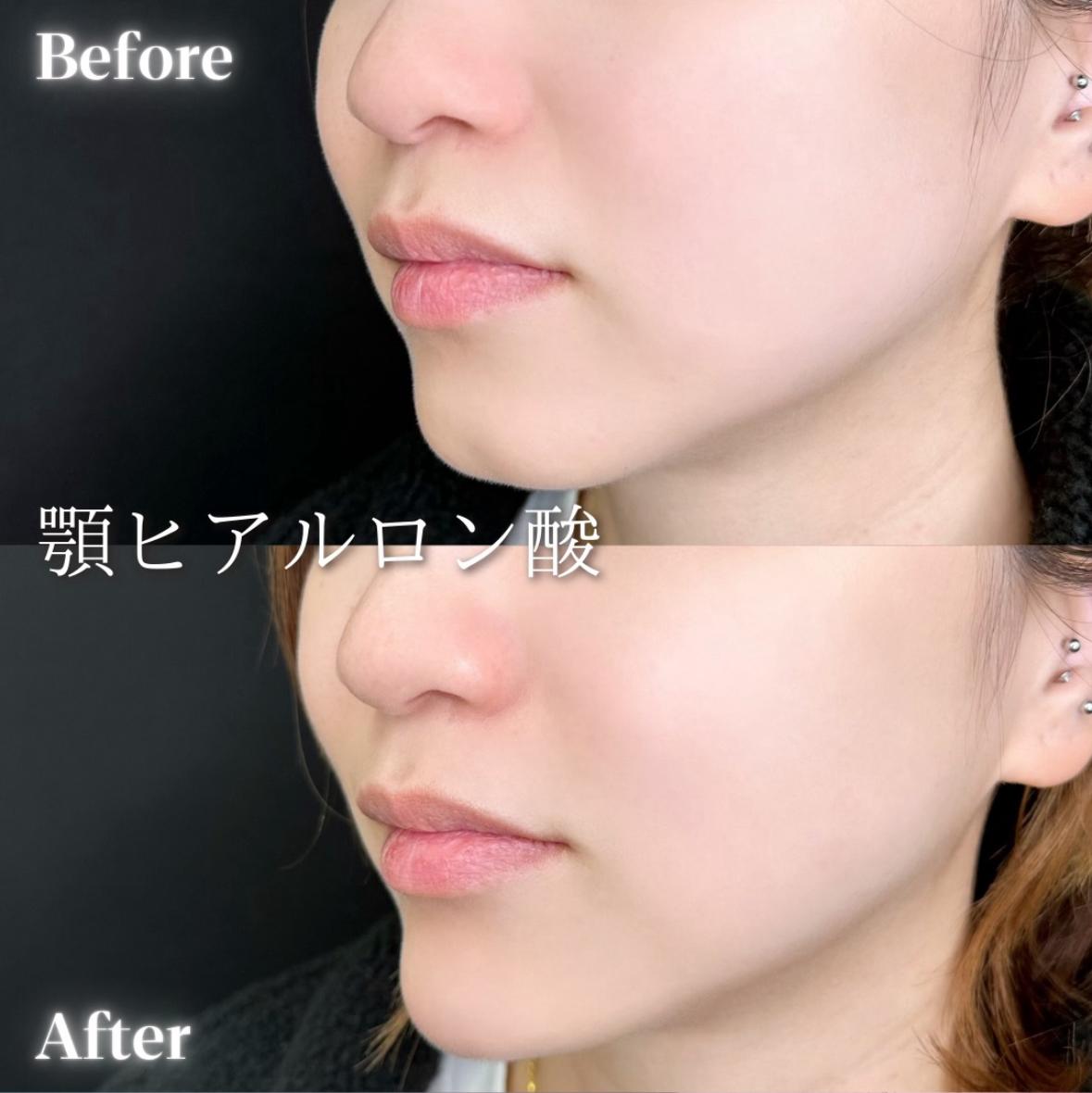 アゴクレヴィエルの症例写真